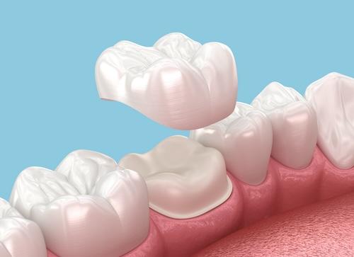 An illustration of a Dental Crowns and Bridges in Pampa, TX