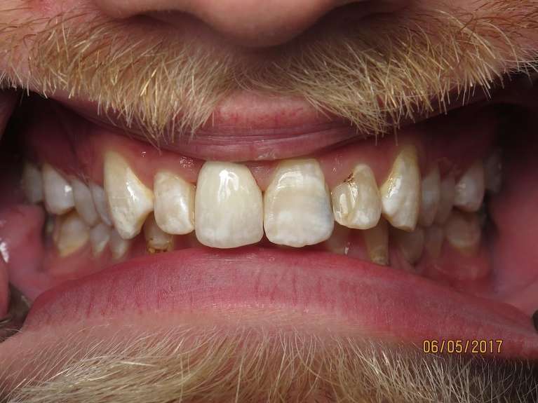 An after image of Broken Front Tooth in Pampa, TX