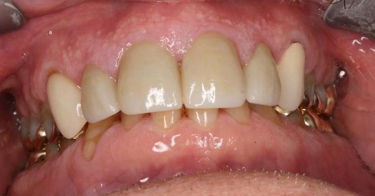 An image of Teeth after getting Ceramic Crowns in Pampa, TX