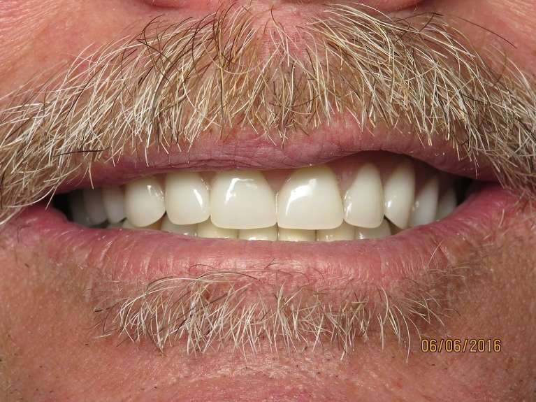 An image of Teeth after getting Dentures in Pampa, TX