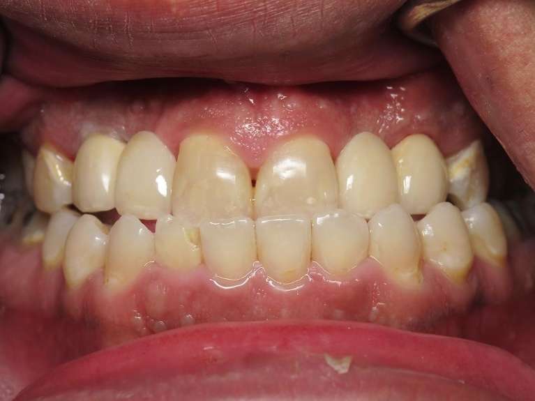 An image of Teeth after getting an Implant Bridge in Pampa, TX