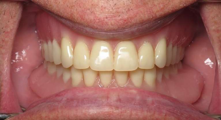 An image of Teeth after getting an Implant denture in Pampa, TX