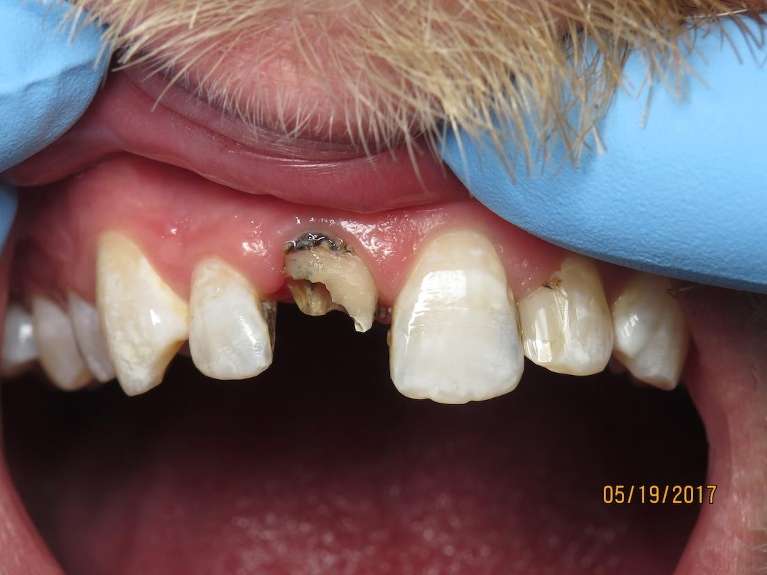 A before image of Broken Front Tooth in Pampa, TX