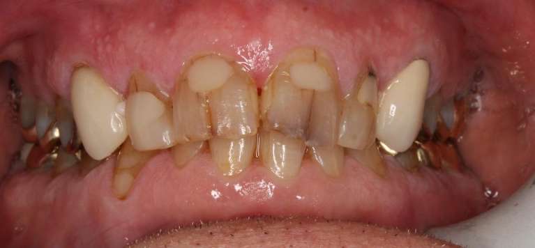 A before image of Teeth before getting Ceramic Crowns in Pampa, TX