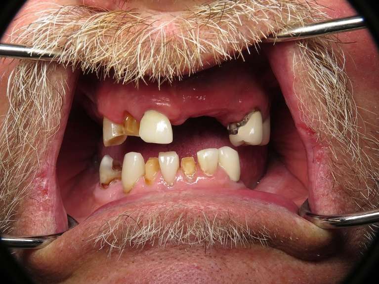 A image of Teeth before getting Dentures in Pampa, TX