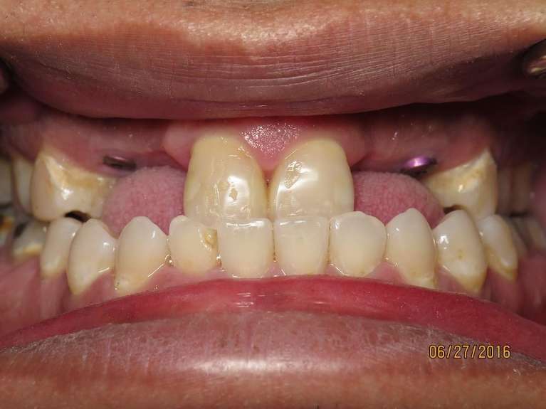 An image of Teeth before getting an Implant Bridge in Pampa, TX