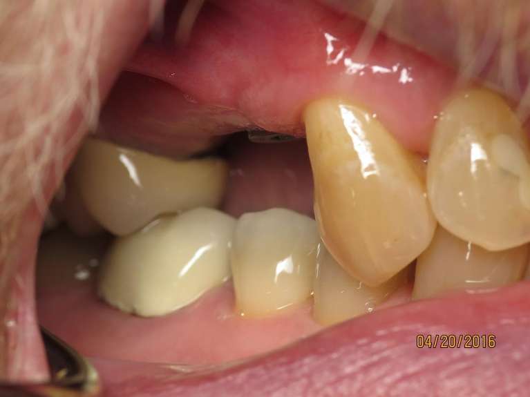 An image of Teeth before getting an Implant Crowns in Pampa, TX