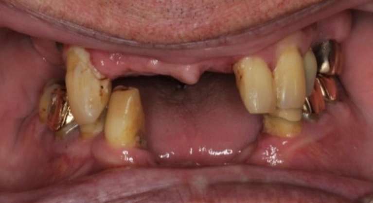 An image of Teeth before getting an Implant denture in Pampa, TX